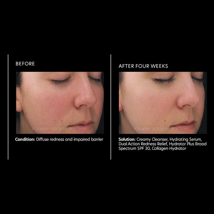 PCA Skin Dual Action Redness Relief 1 oz - European Beauty by B