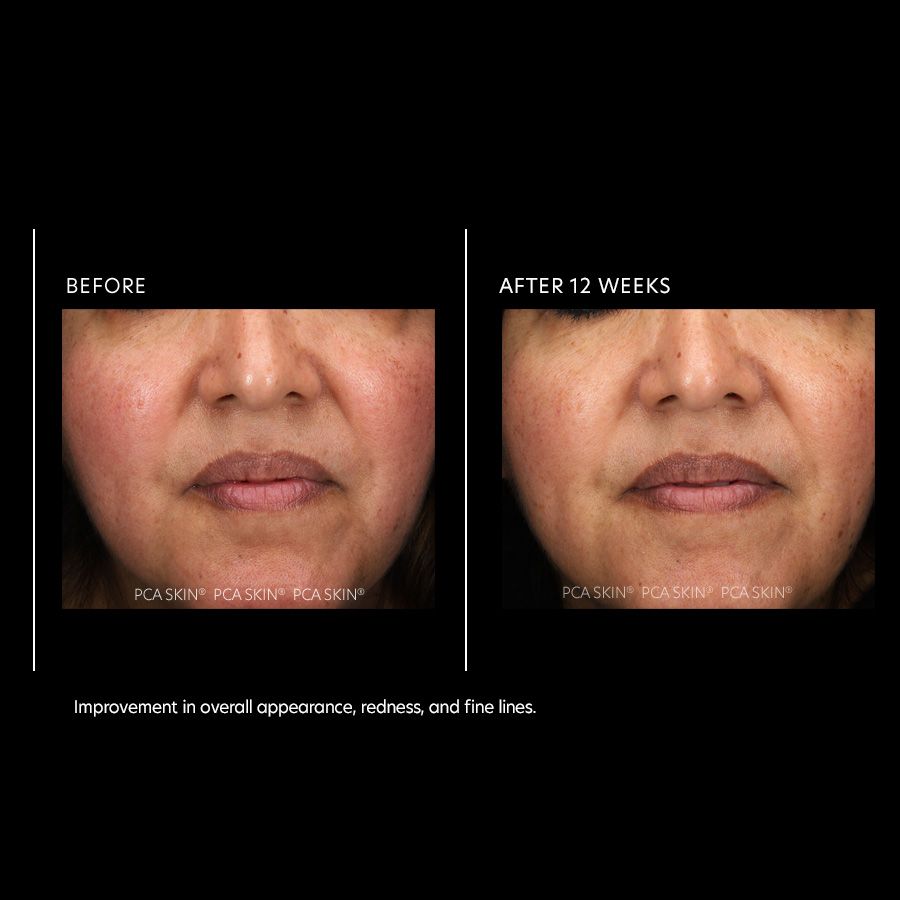 PCA Skin Resurfacing Serum 1 fl oz