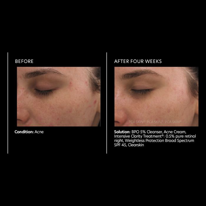 PCA Skin Intensive Clarity Treatment 0.5% Pure Retinol & Salicylic Acid 1 oz - European Beauty by B
