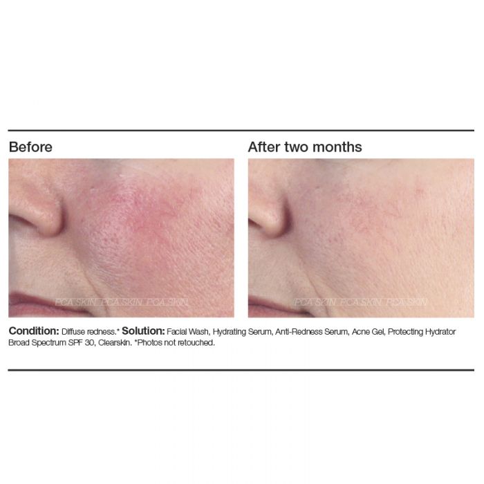 PCA Skin Anti-Redness Serum 1 oz - European Beauty by B